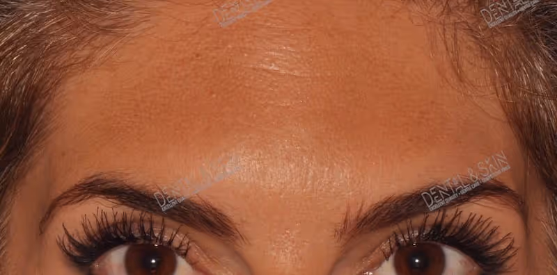 After Treatment