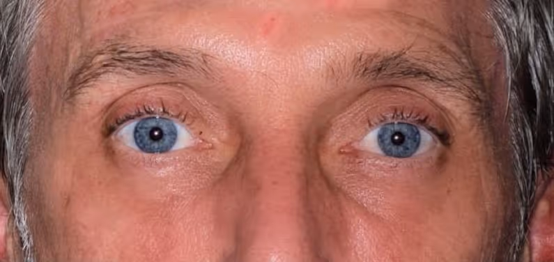After Treatment