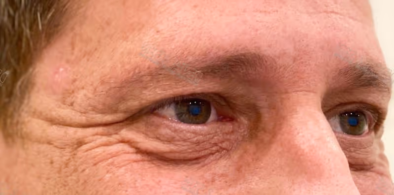 Before Treatment