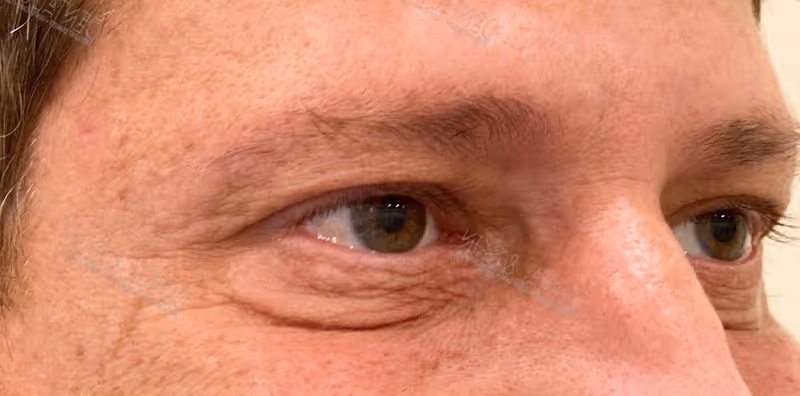 After Treatment