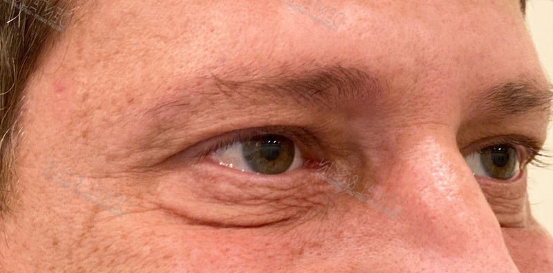 After Treatment