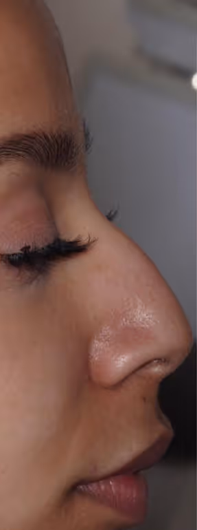 Before Treatment