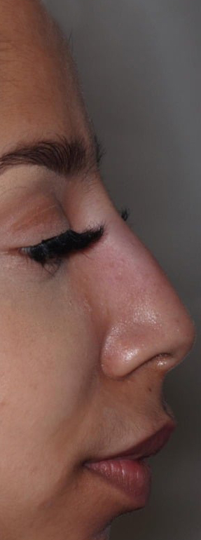 After Treatment