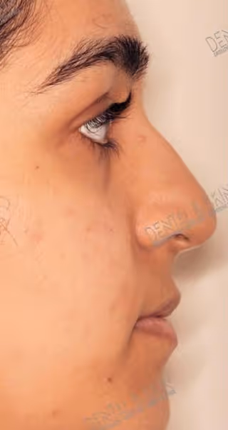Before Treatment