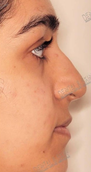 Before Treatment