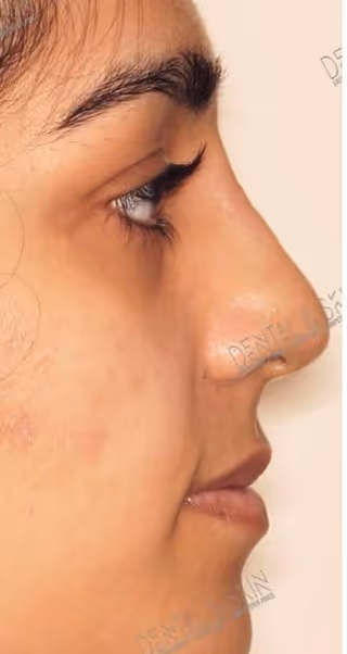 After Treatment