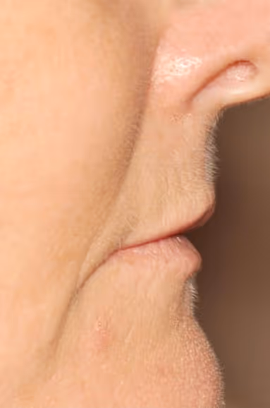 Before Treatment