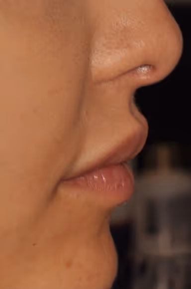 Before Treatment