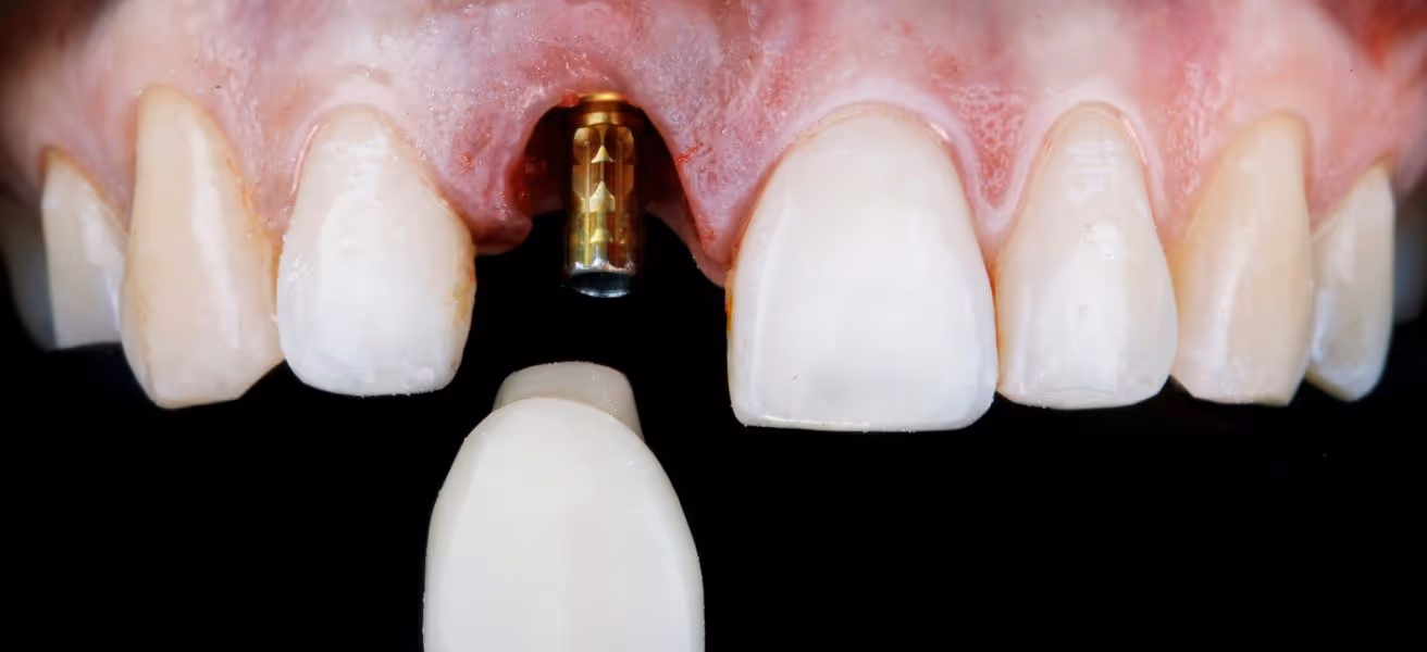 Implantologie dentaire : implants, étapes et prix