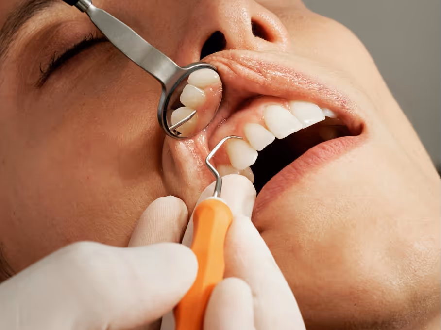 Gingivite : symptômes, causes, prévention et traitements
