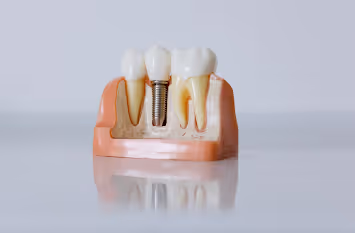 Péri-implantite : enjeux, diagnostics et stratégies thérapeutiques en implantologie