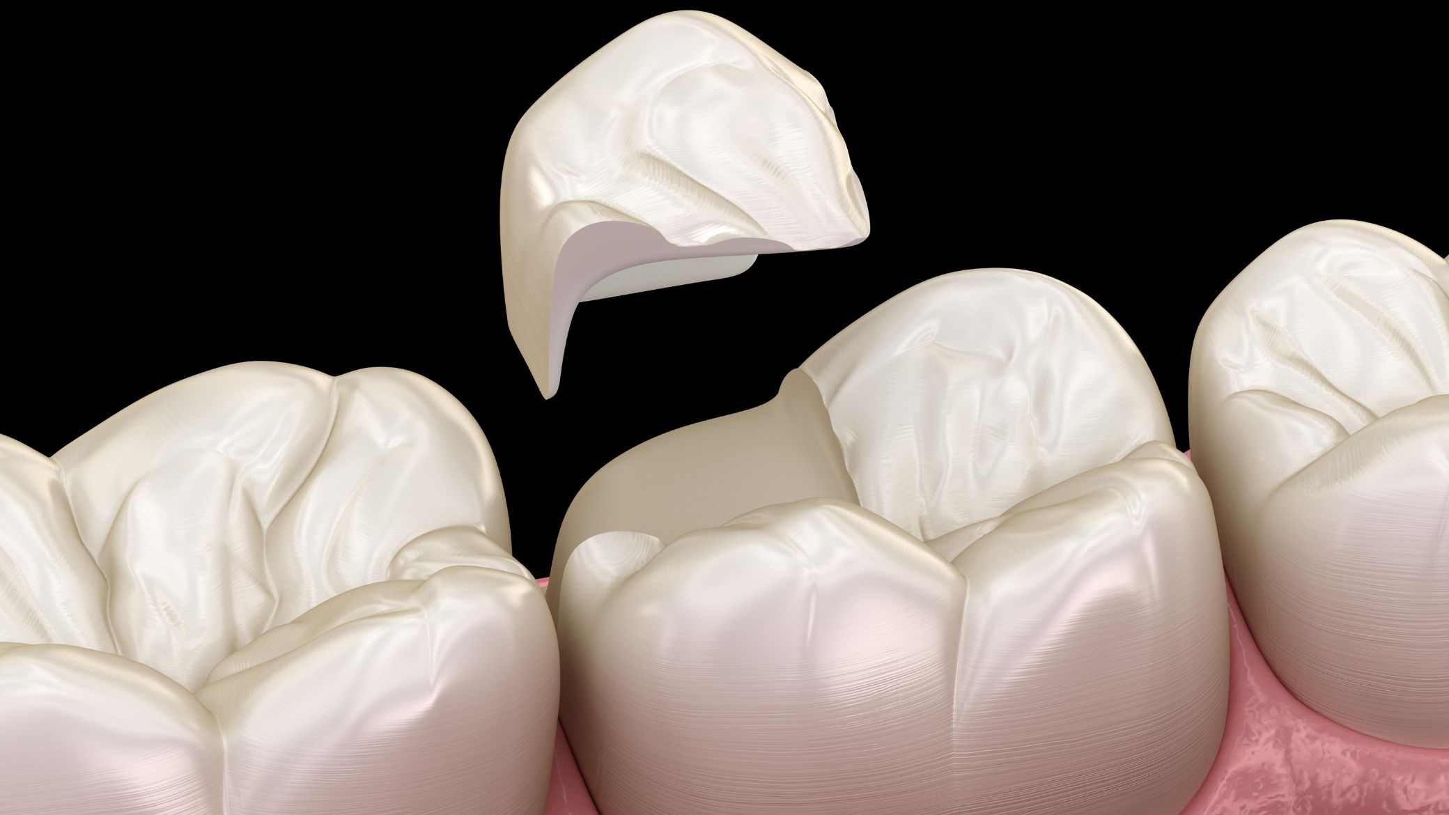 Onlay dentaire : définition, pose, matériaux, prix & remboursement