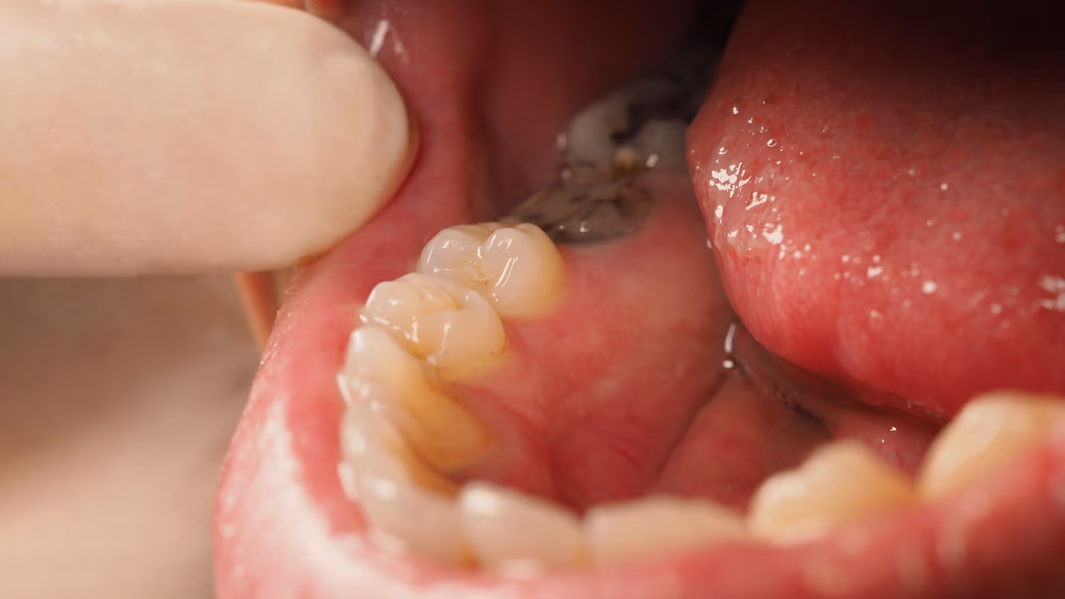 Dévitaliser une dent : pourquoi, comment, à quel prix ? Le guide complet