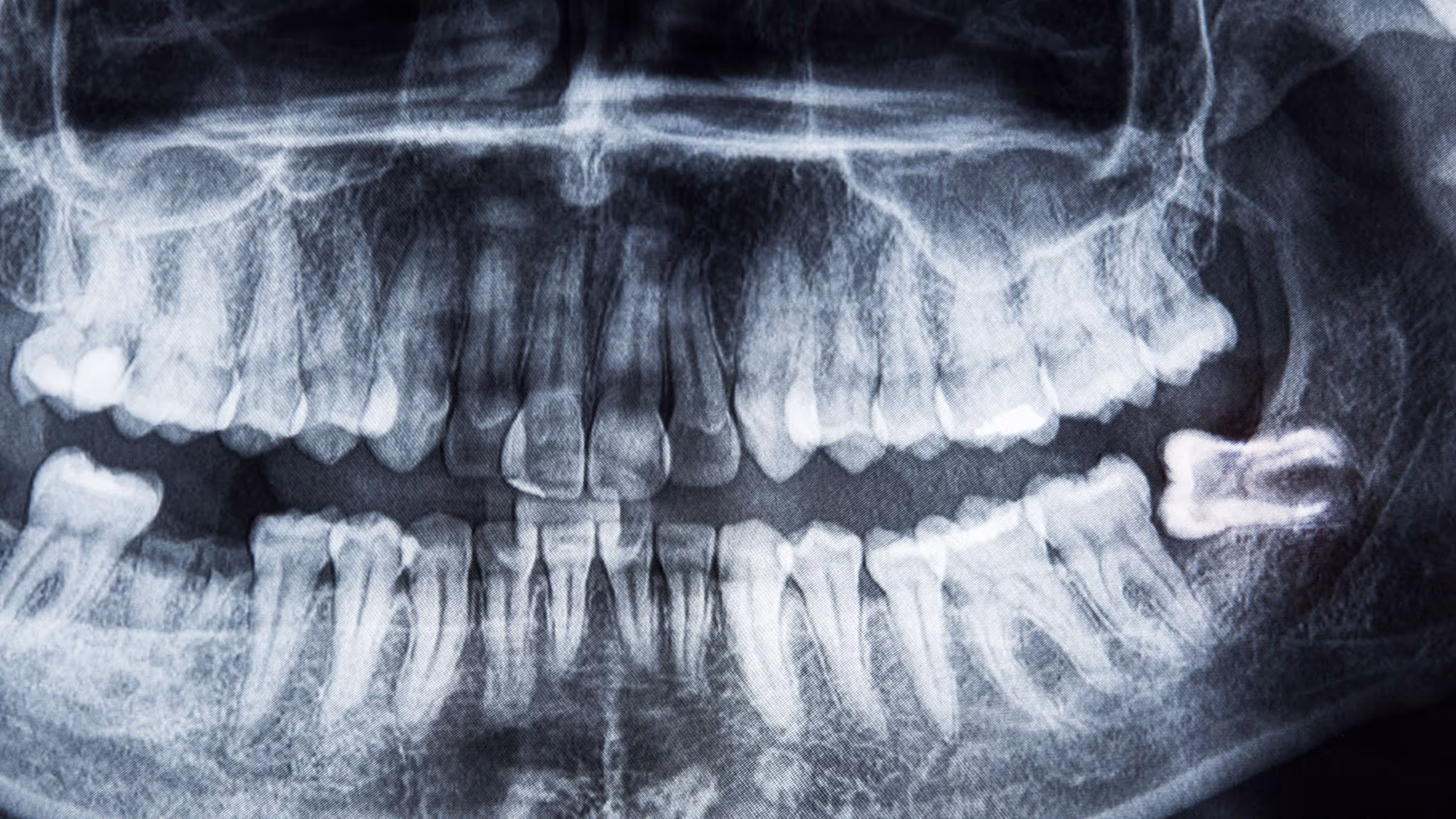 Cone Beam dentaire : dangereux ou utile ?