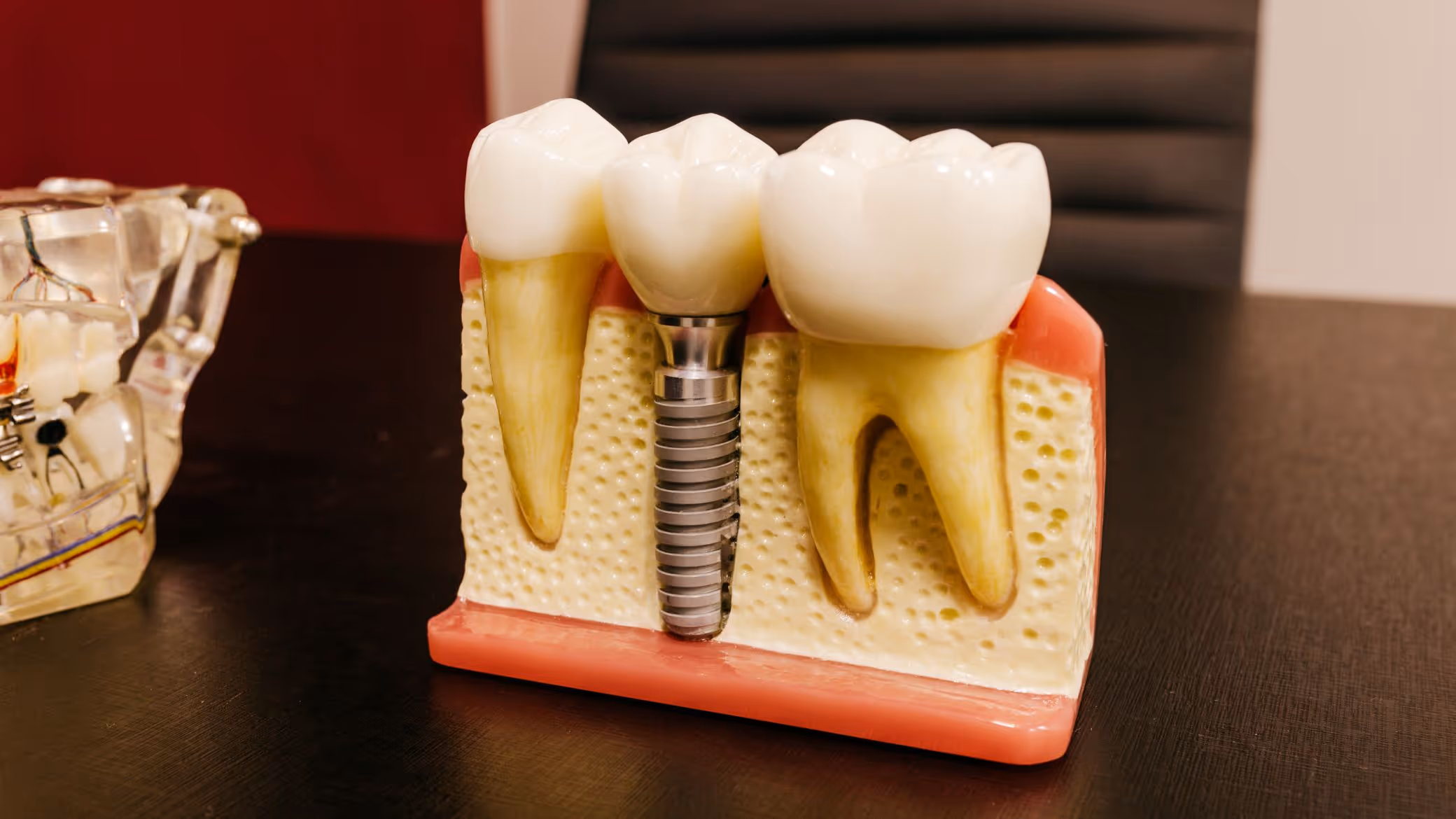 Péri-implantite : symptômes, causes et traitements