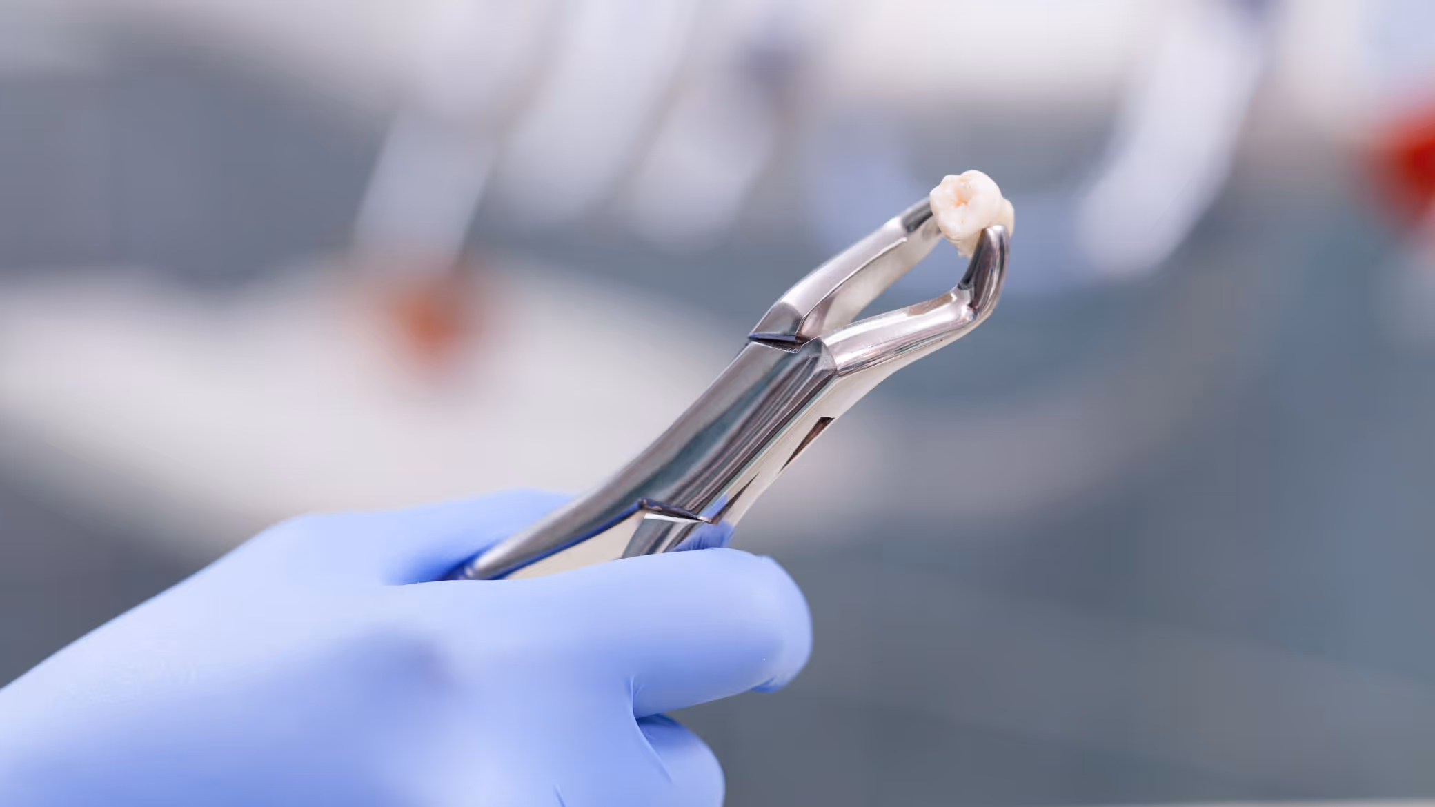 Extraction dentaire : déroulement, douleur et soins