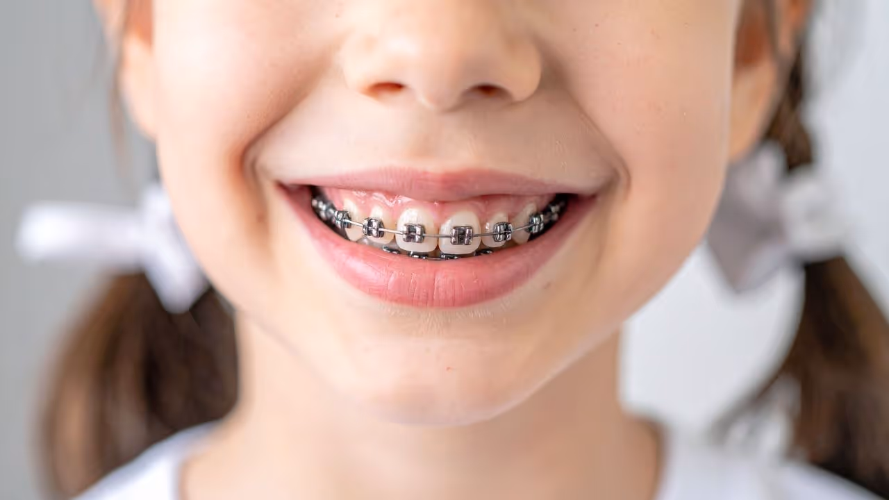 Orthodontie chez l’enfant : âge, appareils, prix et remboursement
