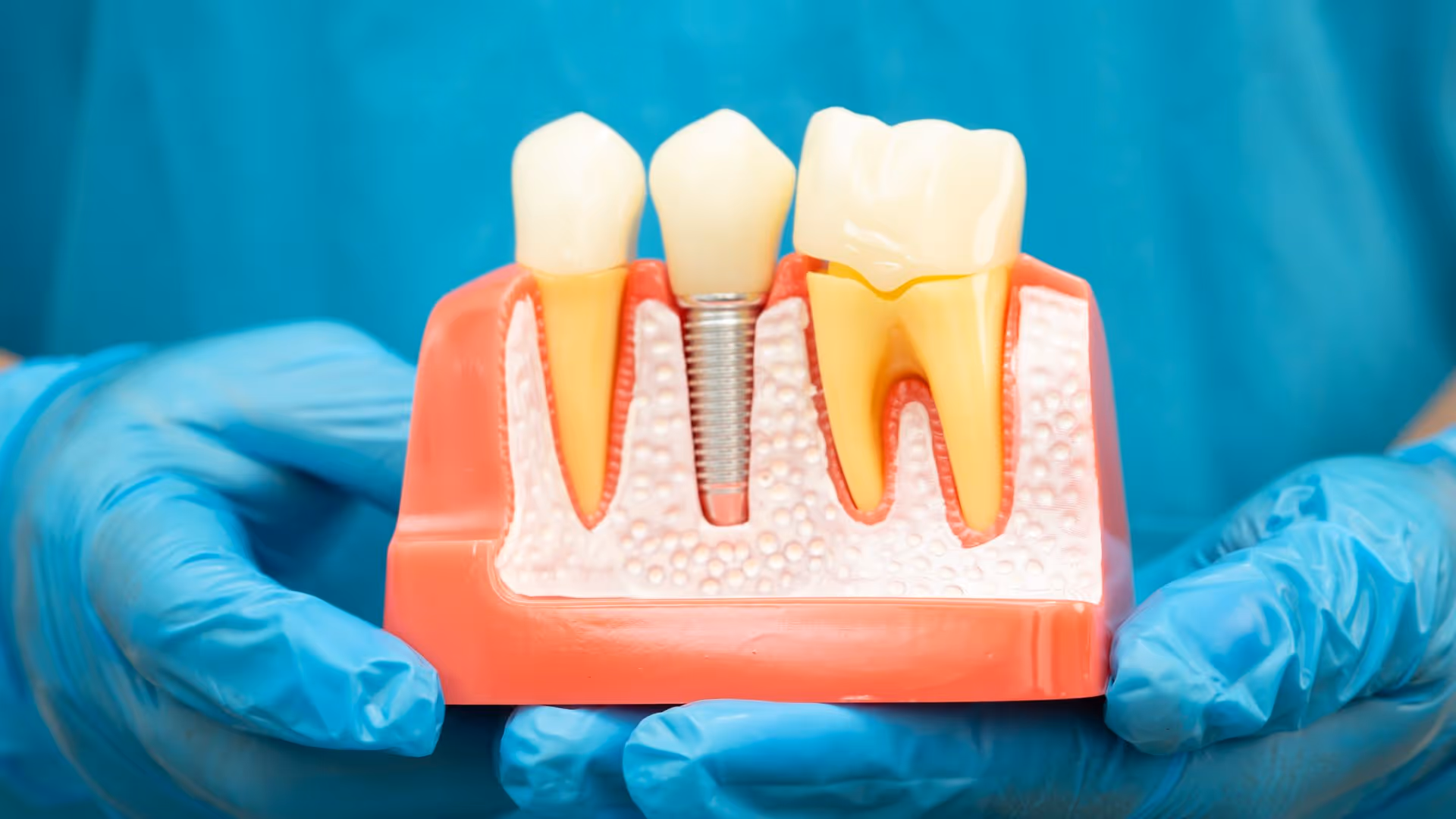 Implant dentaire et remboursement : guide 2026