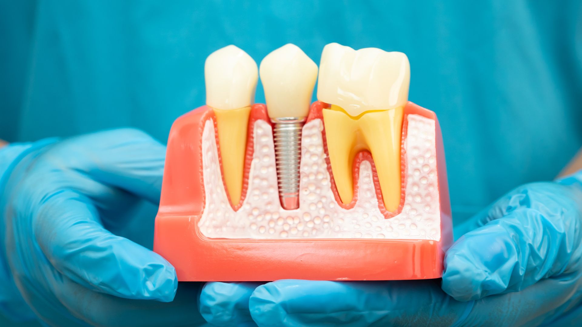 Implant dentaire et remboursement : guide 2026