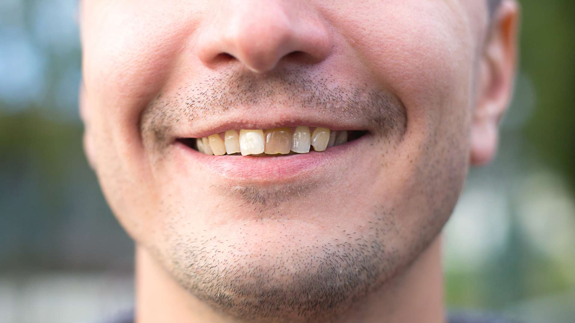 Dent dévitalisée : définition, douleur, prix et suites