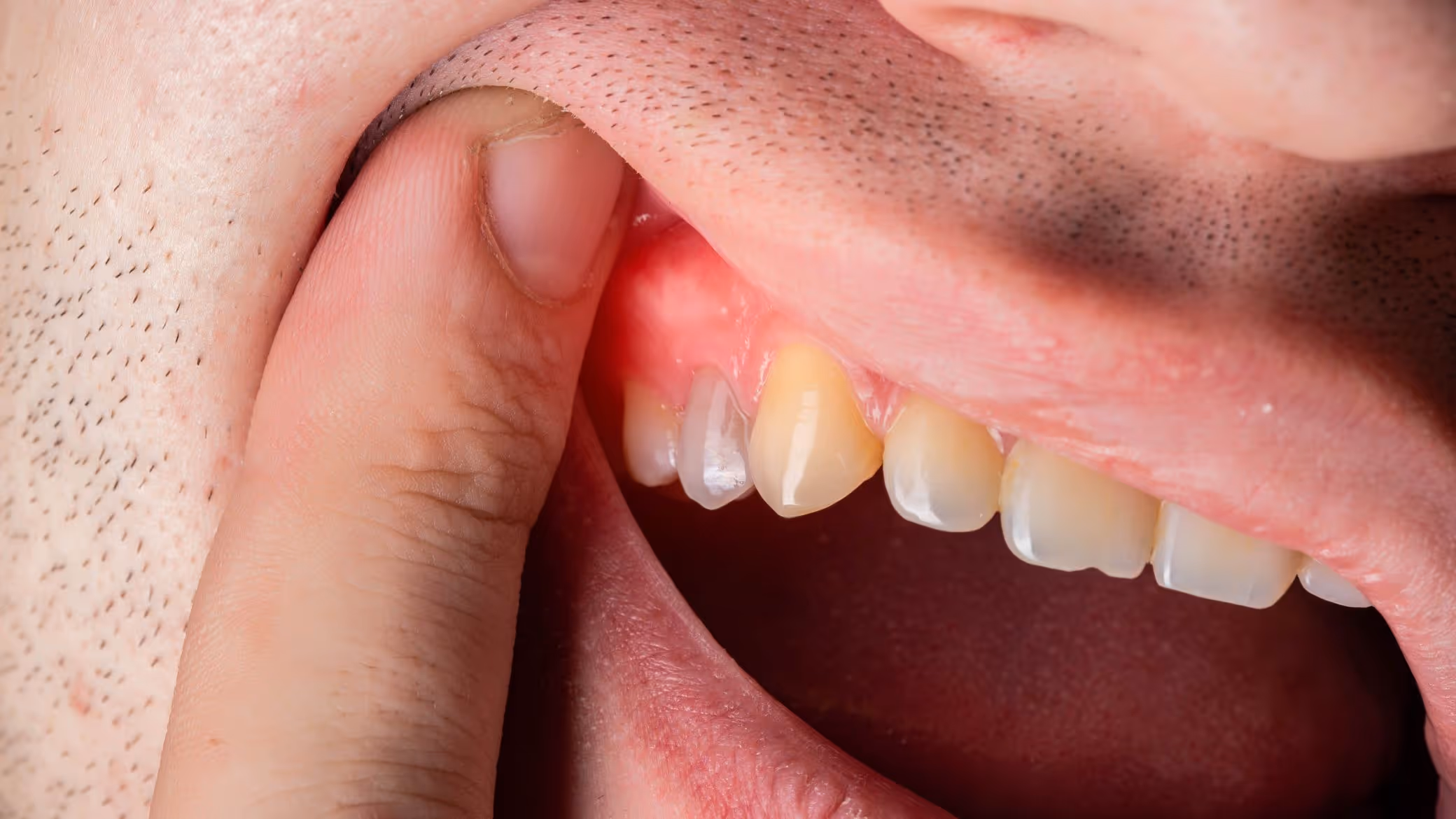 Gencive gonflée : causes, traitements et signes d’alerte