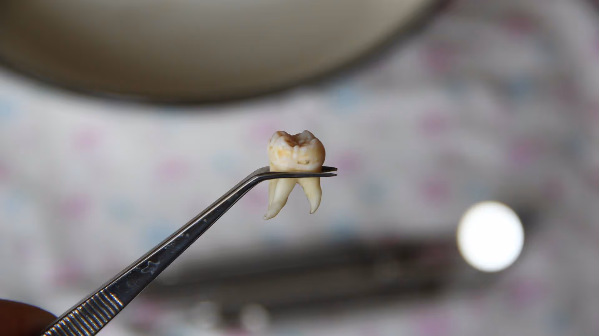 Opération dents de sagesse : déroulé, risques et récupération