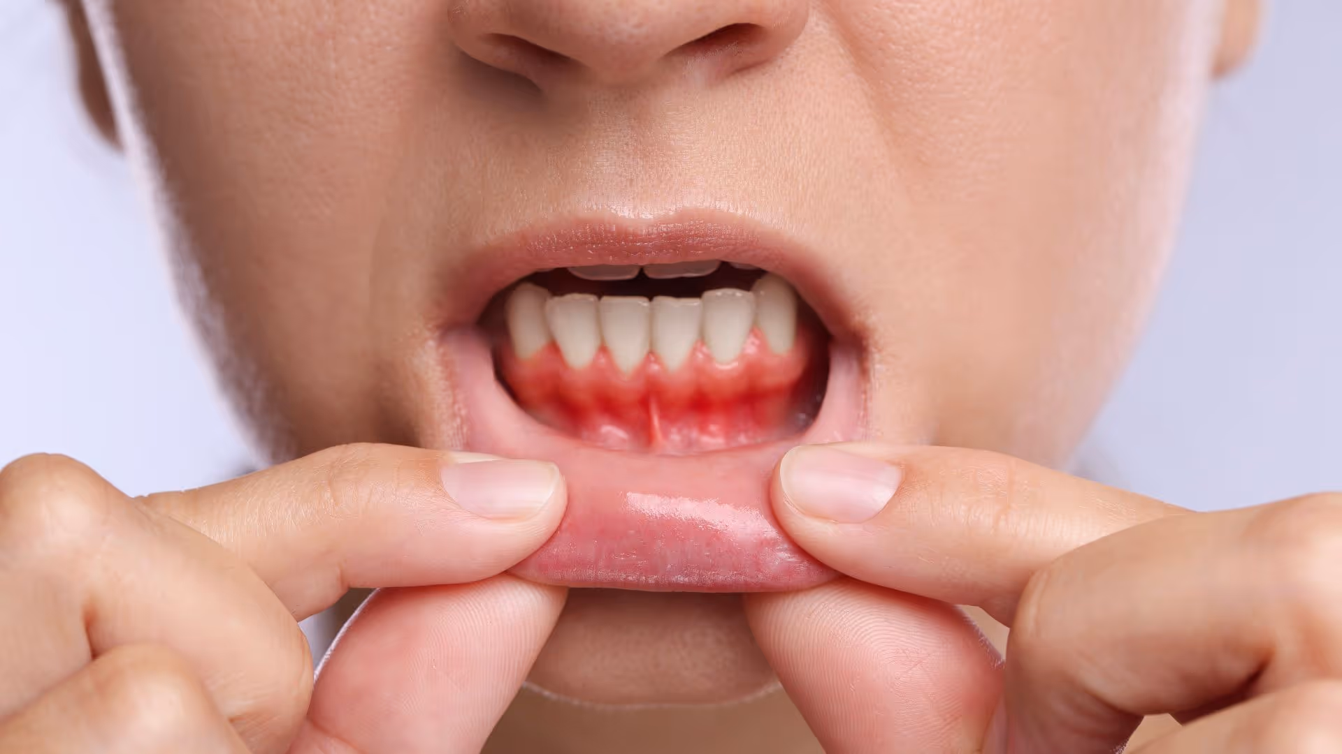 Saignement des gencives : causes, signes d'alerte et solutions
