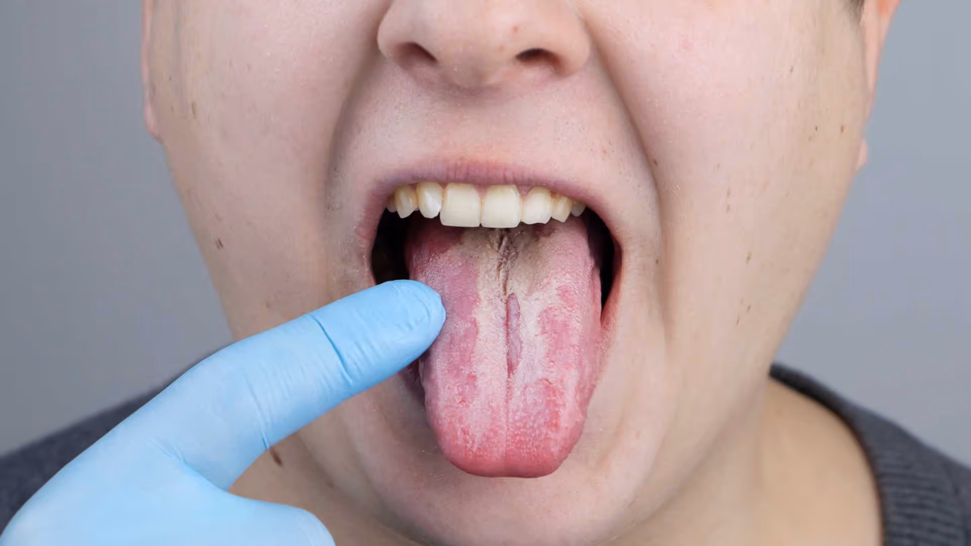 Candidose buccale (muguet) : causes, symptômes, traitements 
