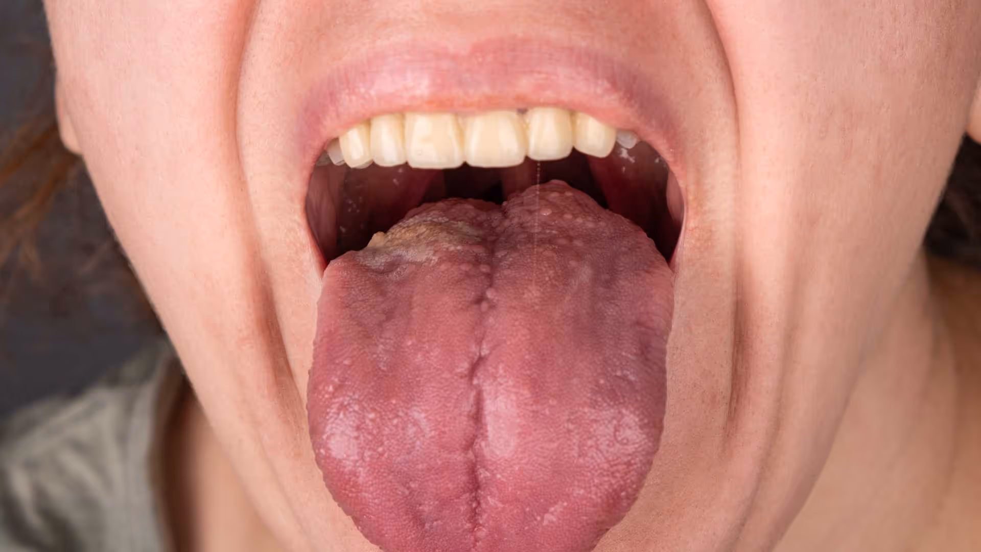 Leucoplasie buccale : causes, risques et traitements