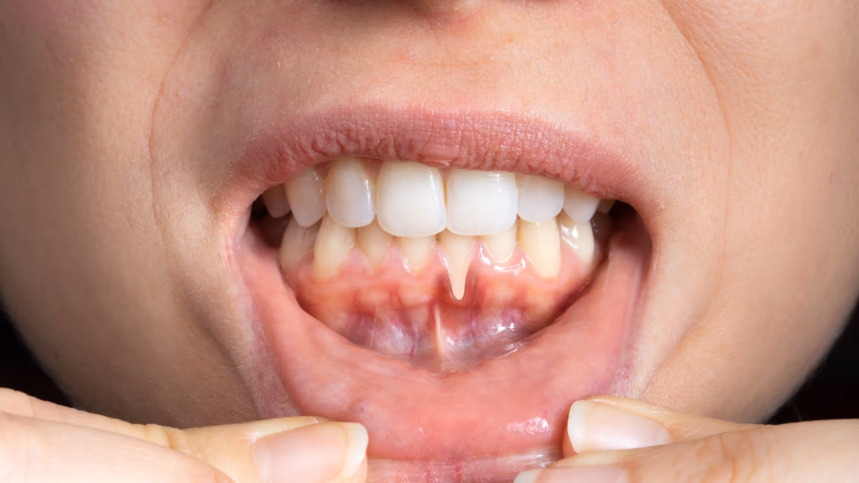 Tout savoir sur la greffe de gencive