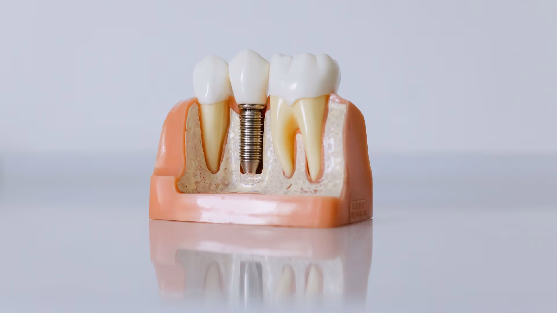 Prothèse sur implant dentaire : types, indications, étapes et tarifs