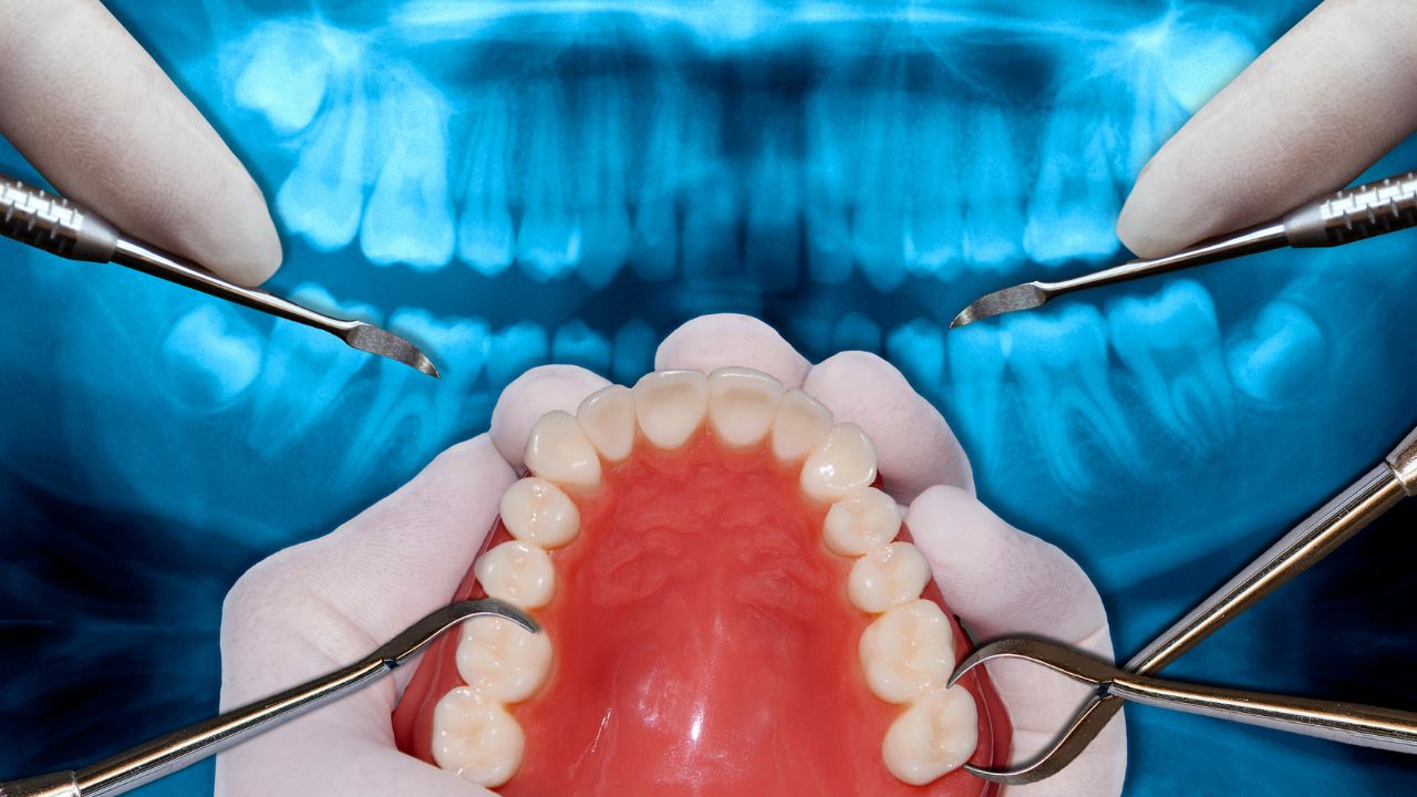 Orthodontie chirurgicale : chirurgie des mâchoires