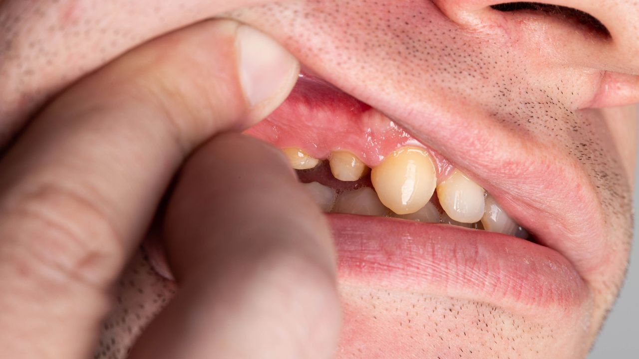 Coller sur dentine sclérotique : pourquoi le protocole standard échoue