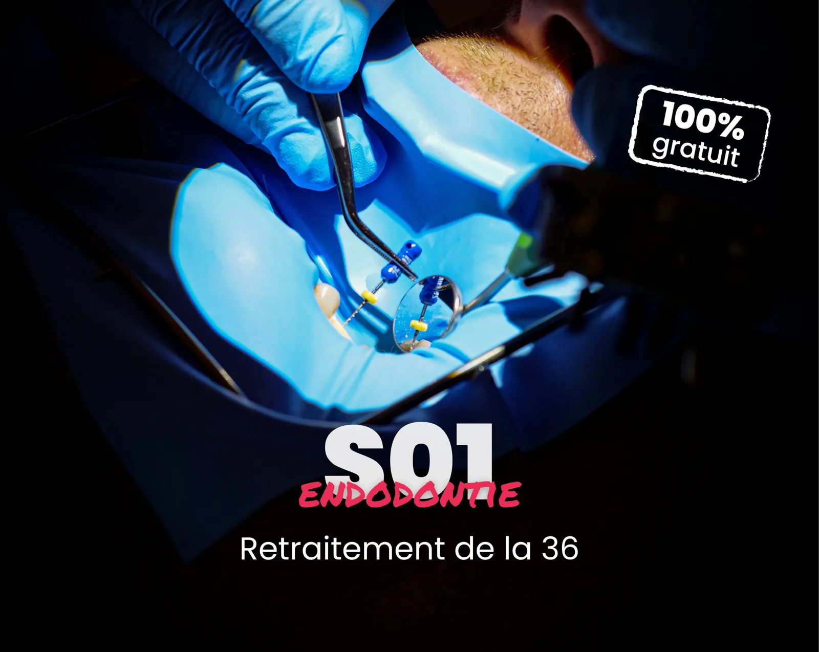 Extrait offert - MasterClass Endodontie Saison 1 - Retraitement de la 36