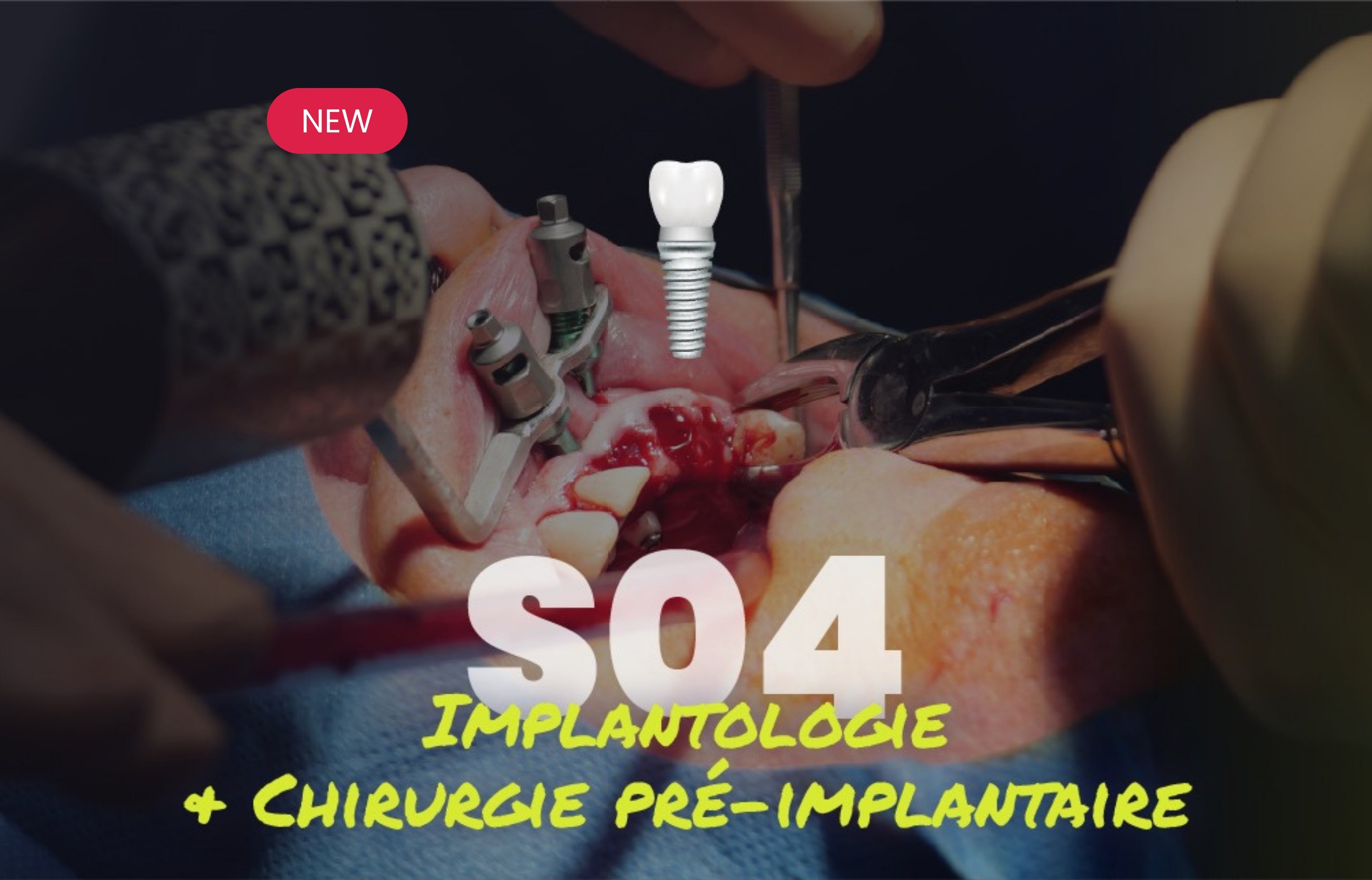 Implantologie et chirurgie pré-implantaire - Saison 4