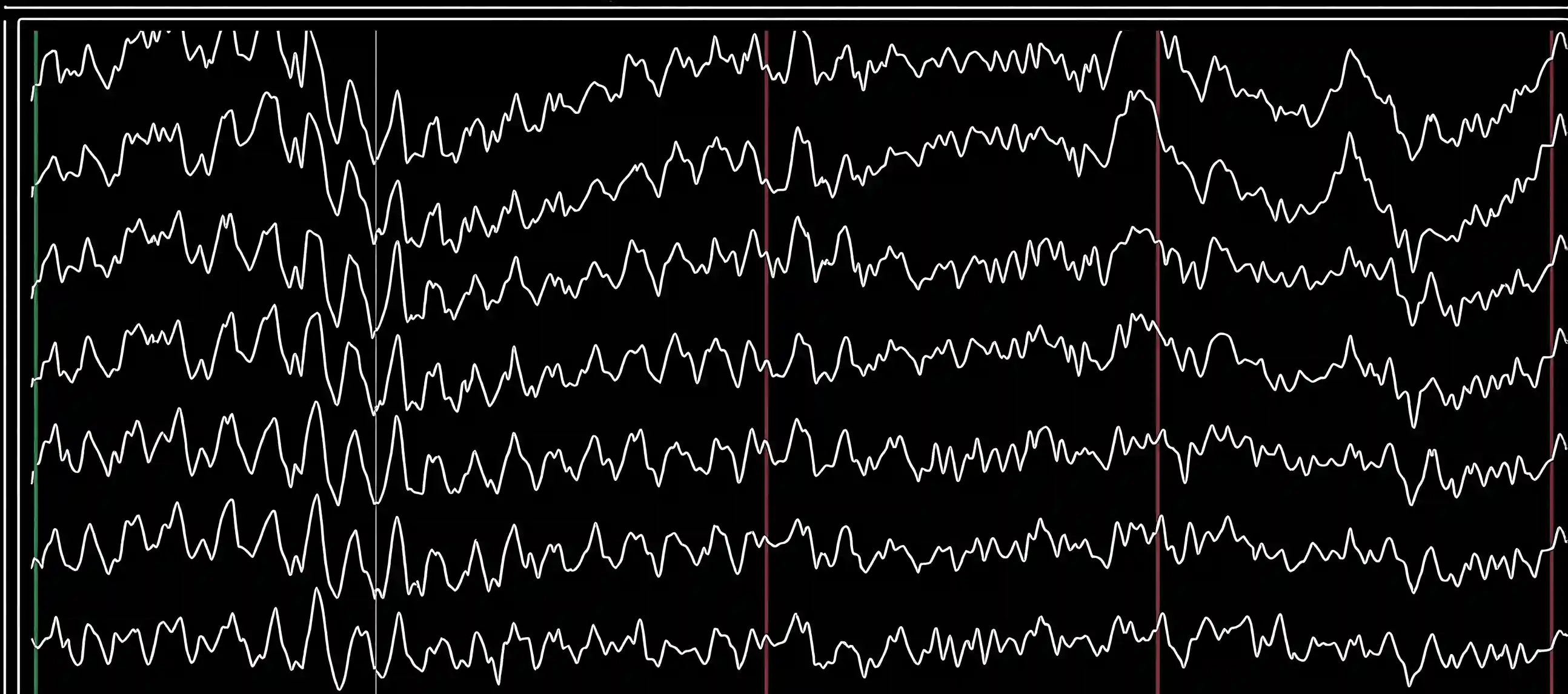 EEG-Hirnstromkurven mit verschiedenen Kanälen und deren elektrischen Aktivitäten in mV dargestellt.