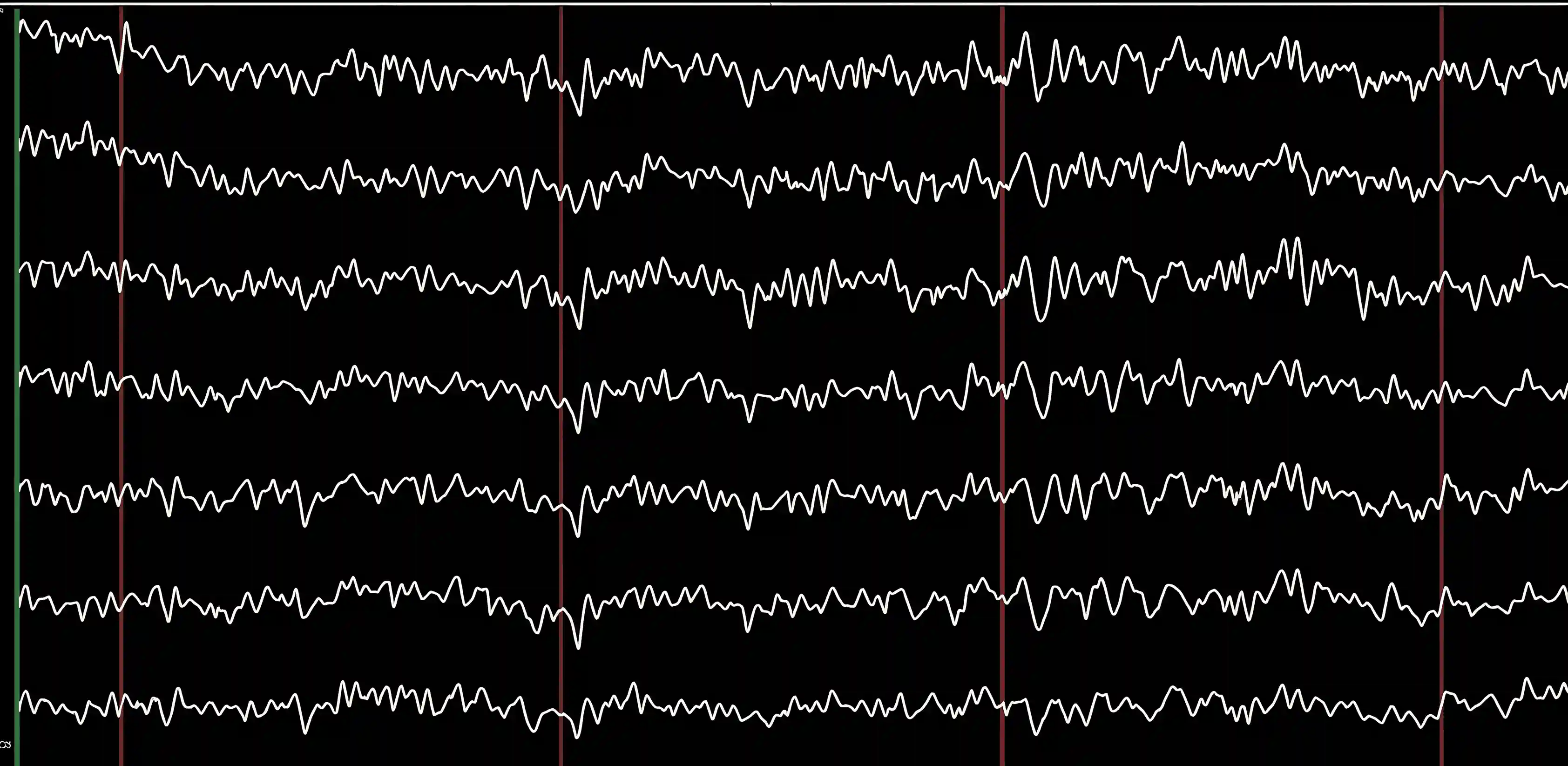 EEG-Hirnstromkurven mit verschiedenen Kanälen und deren elektrischen Aktivitäten in mV dargestellt.