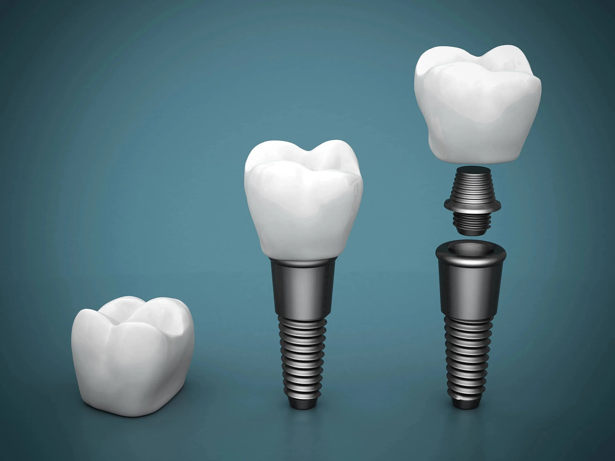 3D illustration of dental implant structure, good dental implants near you