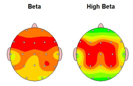 Mapa cerebral de duas imagens com aumento de atividade a vermelho.