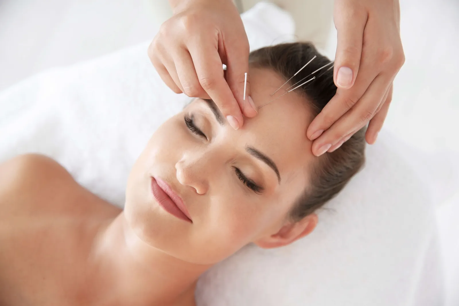 Acupuncturist placing fine needles in a woman's forehead