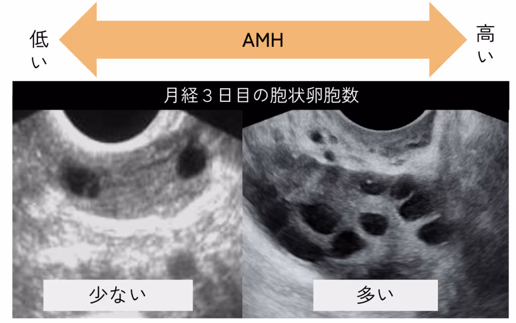 AMH - 月経3日目の胞状卵胞数