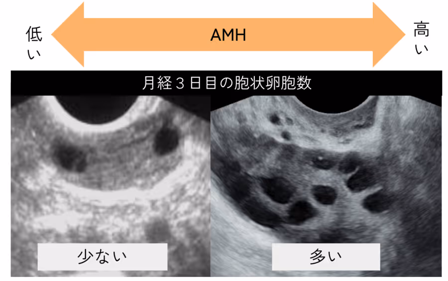 AMH - 月経3日目の胞状卵胞数