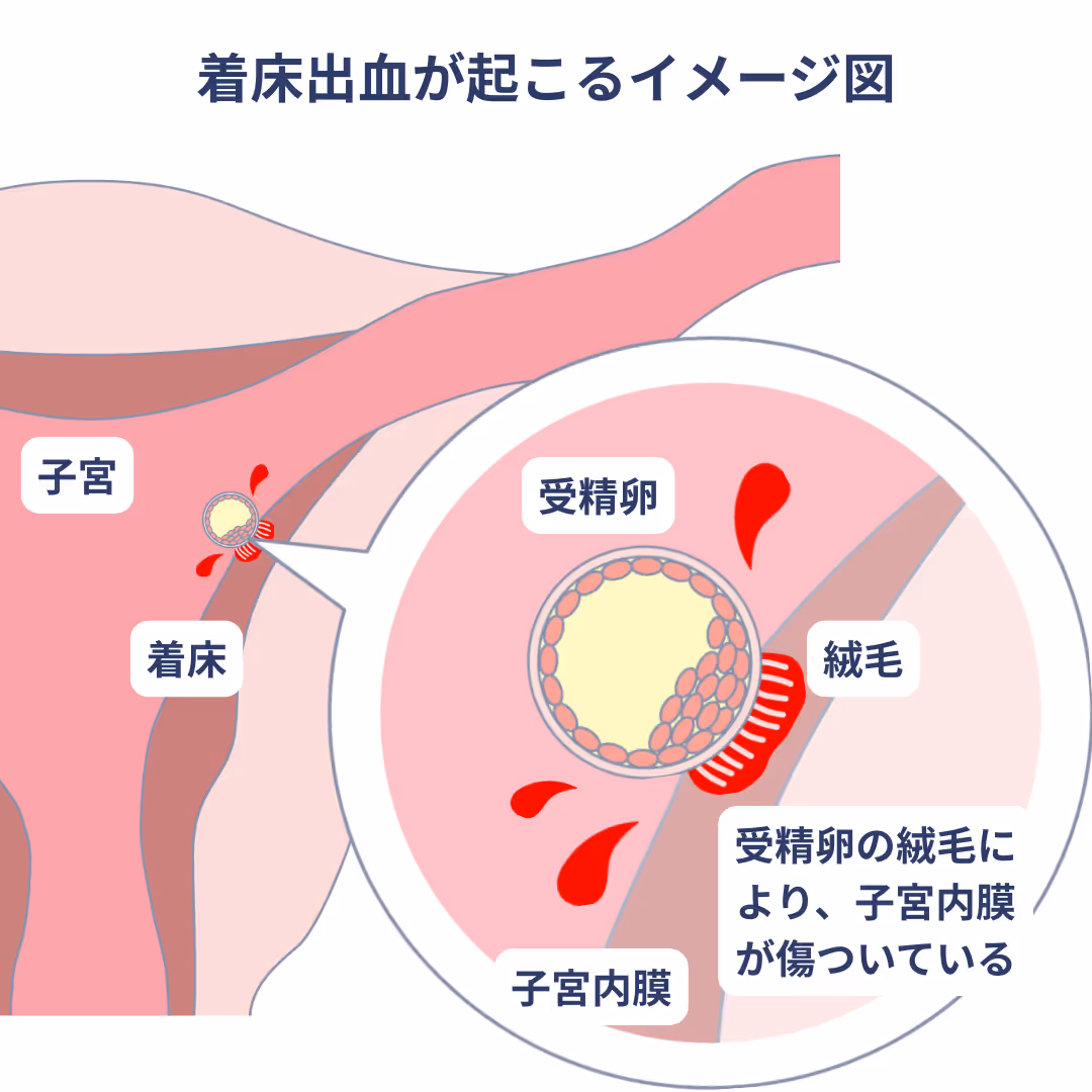 着床出血が起こるイメージ図