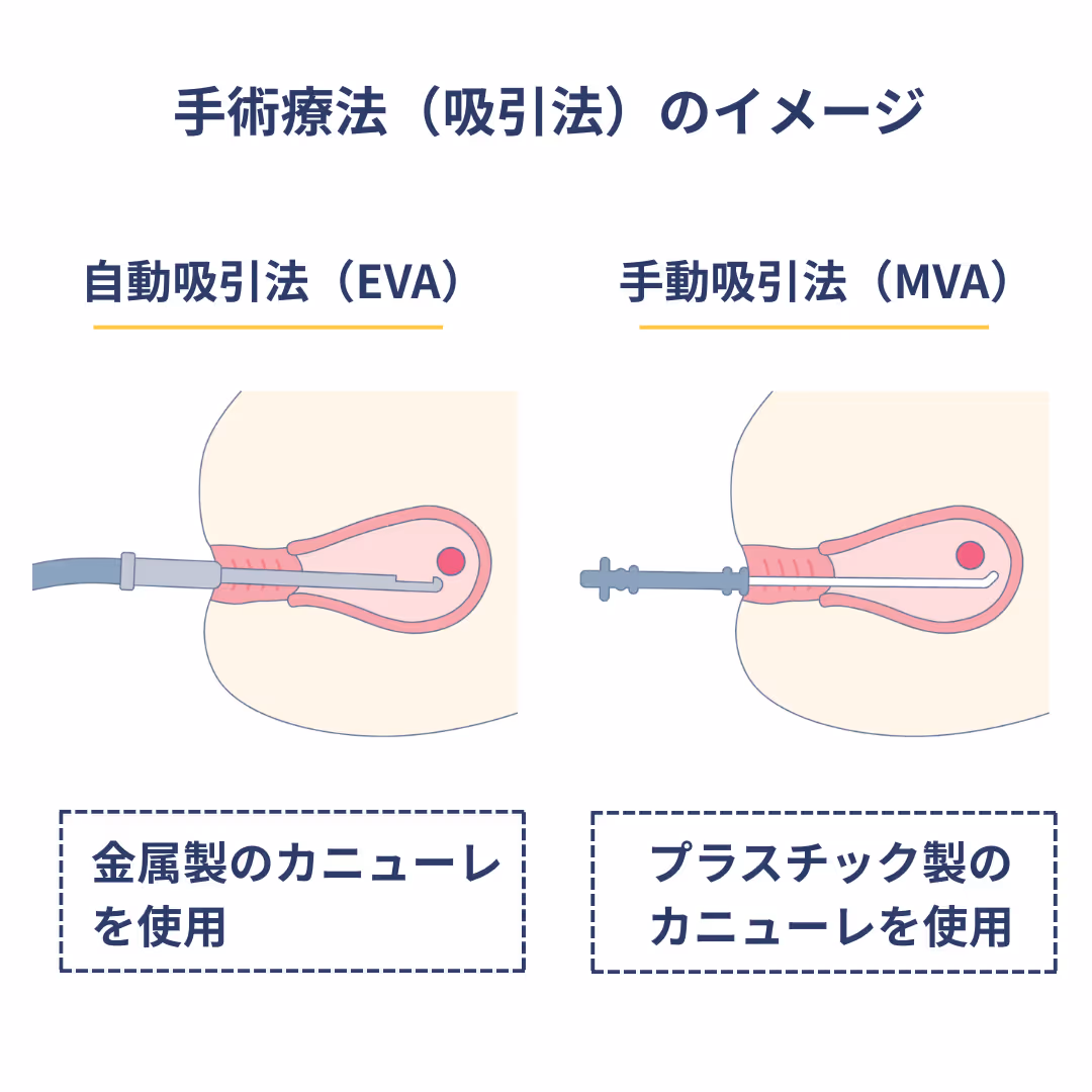 手術療法(吸引法)のイメージ