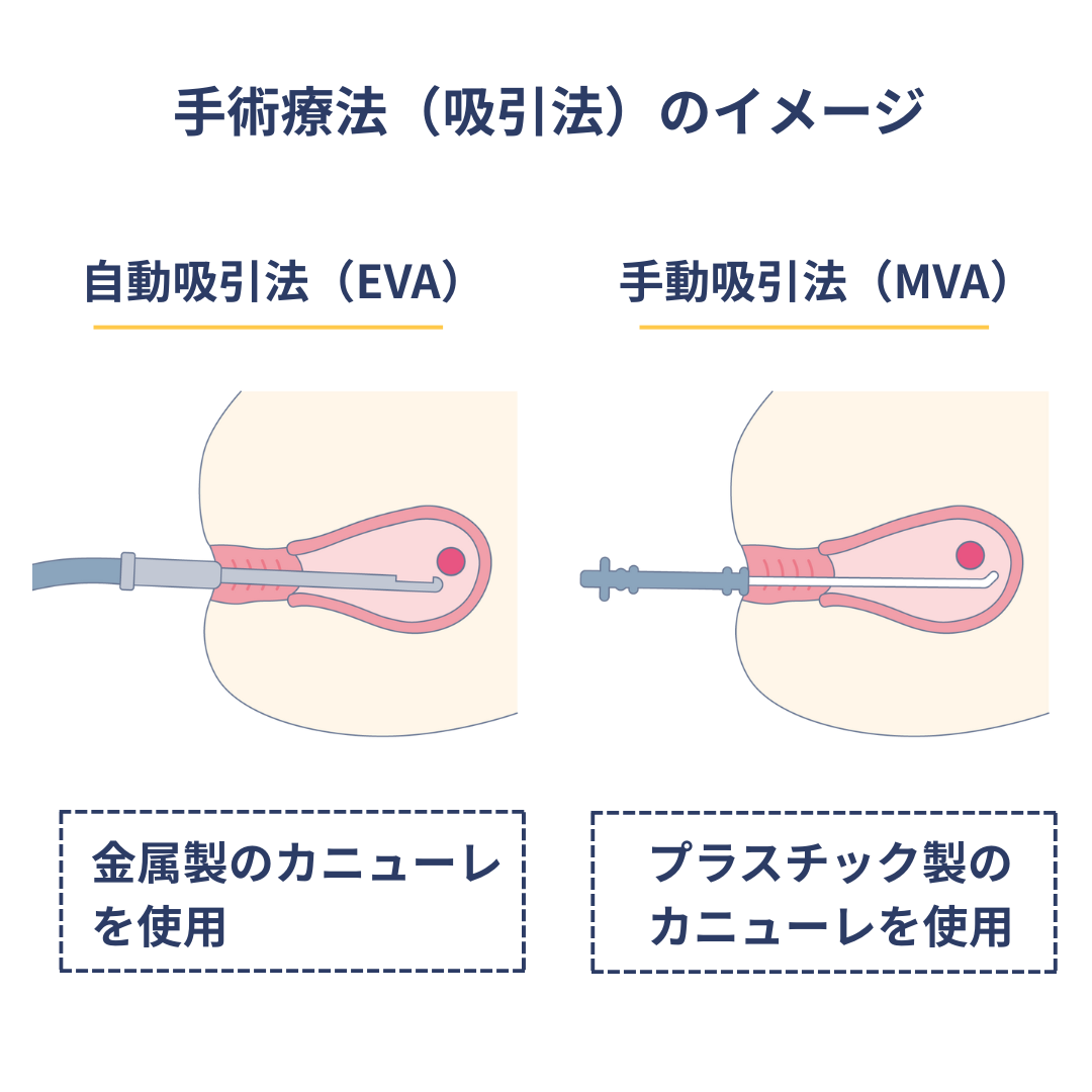 手術療法(吸引法)のイメージ