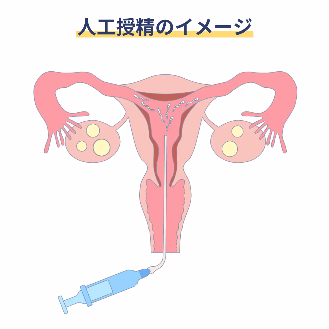 人工授精のイメージ
