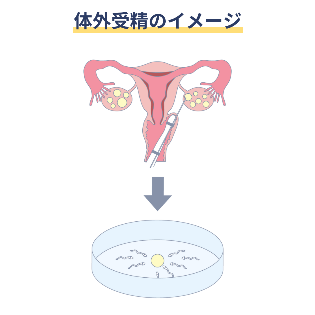 体外受精のイメージ