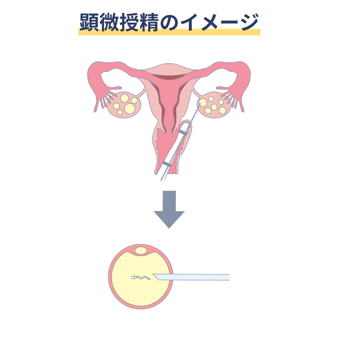 顕微授精のイメージ