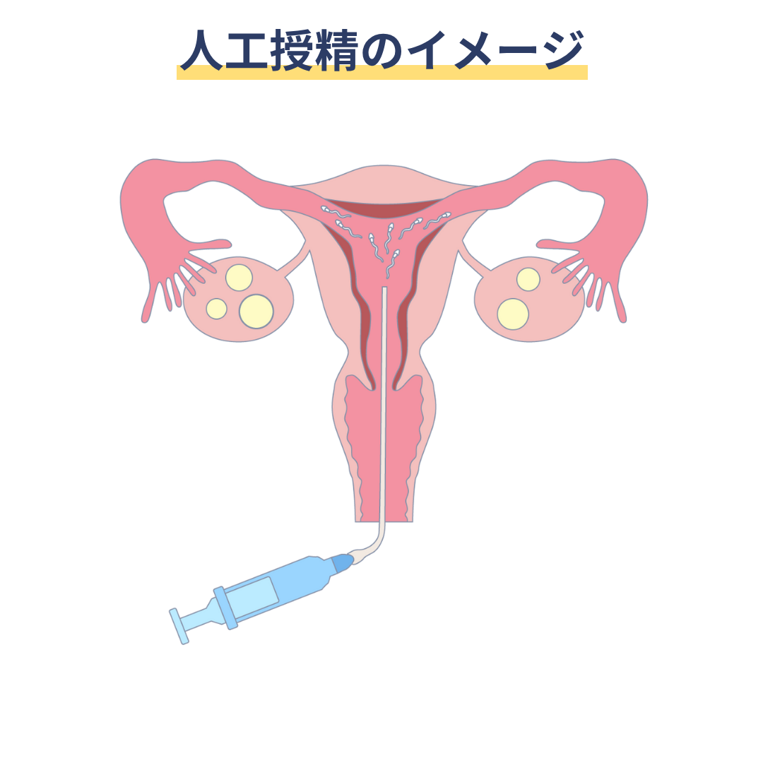 人工授精のイメージ
