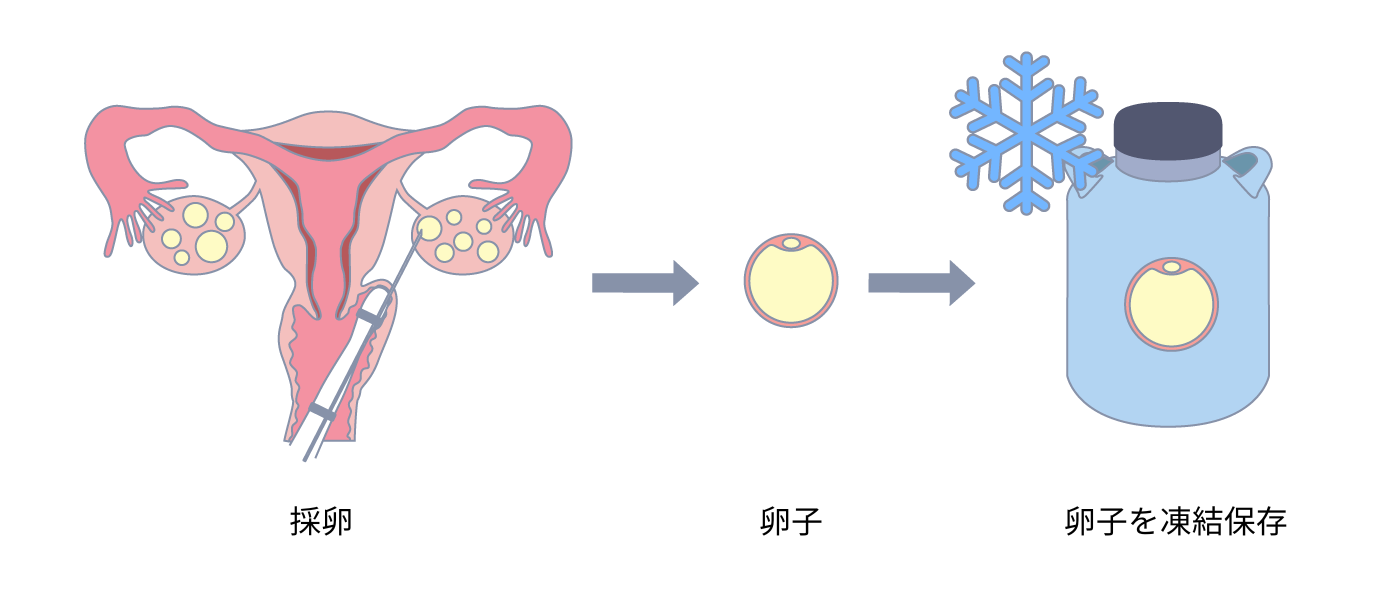 卵子凍結のイメージ